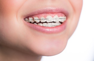 Ortodonti/Şeffaf Plak(Invisalign)